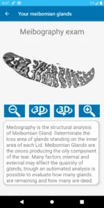 Dry Eye Follow up App 3D Meibography
