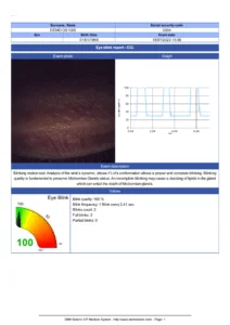 Dry Eye Report Blink
